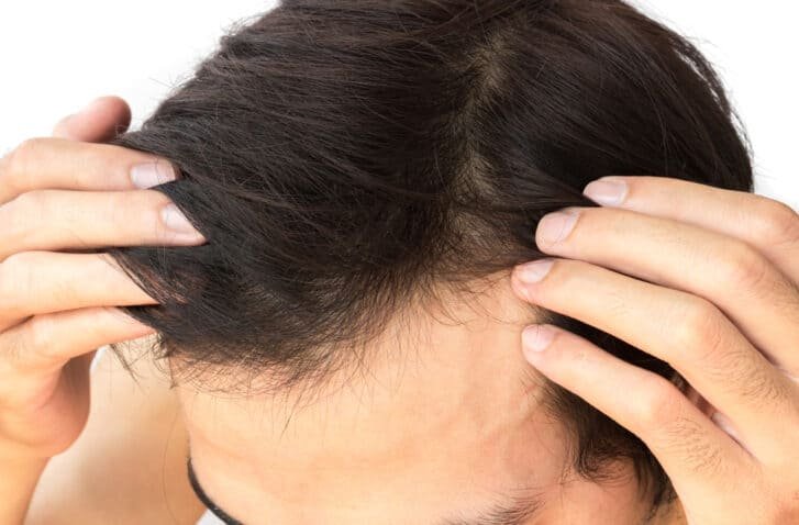 Does Dermaroller Really Work for Hair Regrowth?