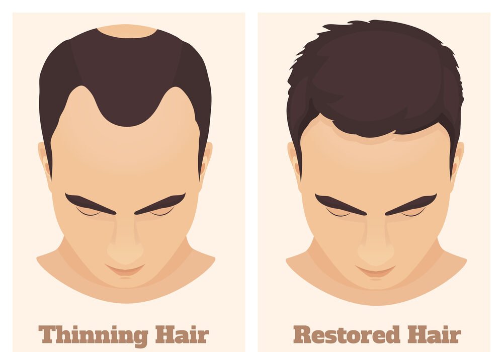 thinning hair, restored hair