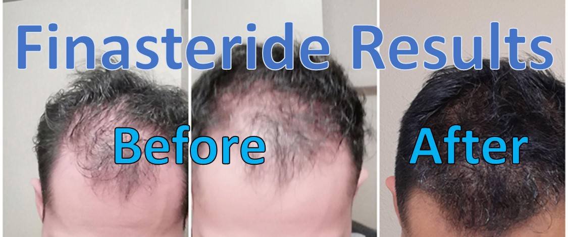 finasteride results 9 months before and after