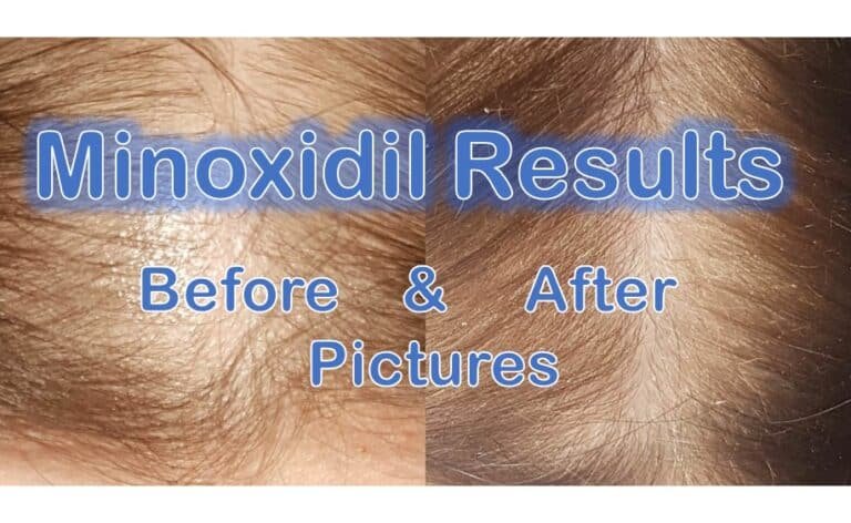 Minoxidil Before And After Pictures (Reddit): Men & Women