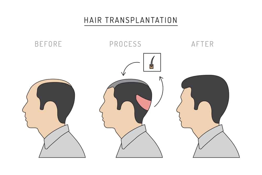 Infographics on the subject of hair transplantation on the example of a man with a picture of the result of transplantation before and after. 