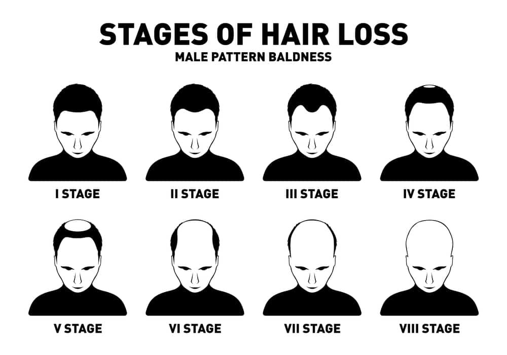 Hair loss. Stages and types of male hair loss. Male pattern baldness. Head of hairy and bald man in top view