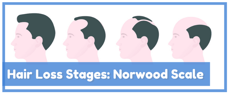 hair loss stages norwood scale