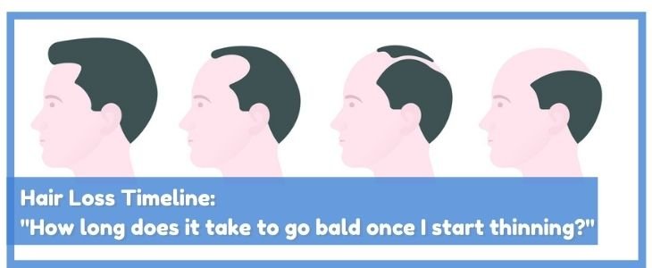 hair loss timeline how long it takes to go bald