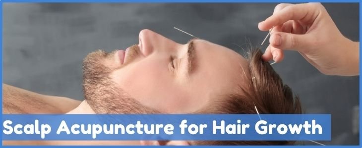 scalp acupuncture treatment for hair loss